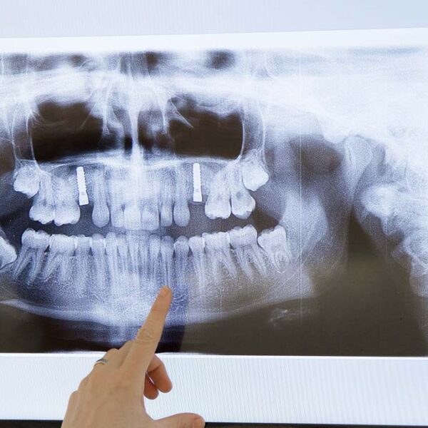 Implantate Zahnarzt Eggenfelden