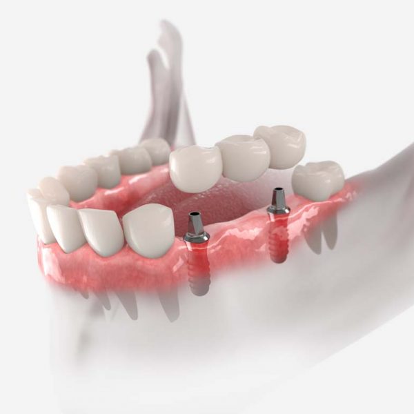 Implantatbrücke Zahnarzt Eggenfelden